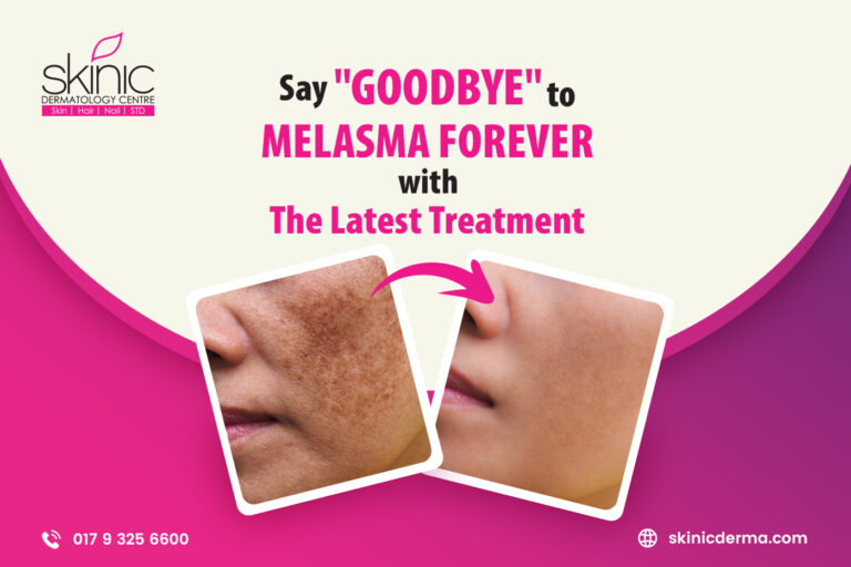 Say “Goodbye” to Melasma Forever with The Latest Treatment